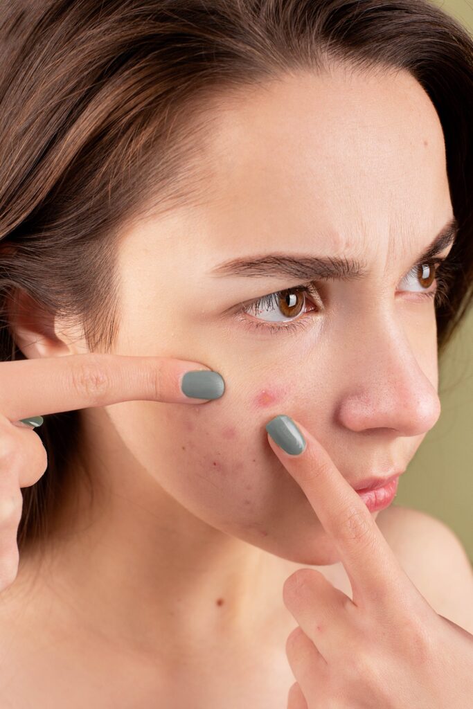 Close-up image of a woman gently touching her acne-prone skin, symbolizing the PCOS symptoms